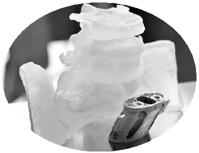 3D打印個體化適型鈦合金人工骶椎