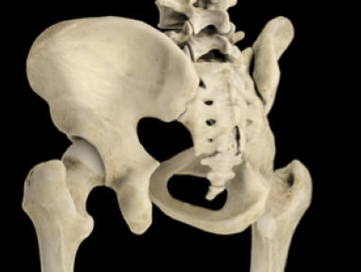 世界首例醫療3D打印應用案例 3D打印假體骶椎成功植入